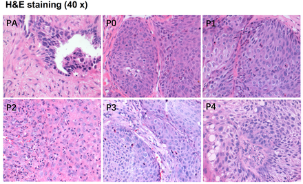 Patient Derived Xenograft Models